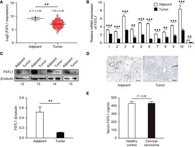 The BMP inhibitor follistatin-like 1 (FSTL1) suppresses cervical carcinogenesis